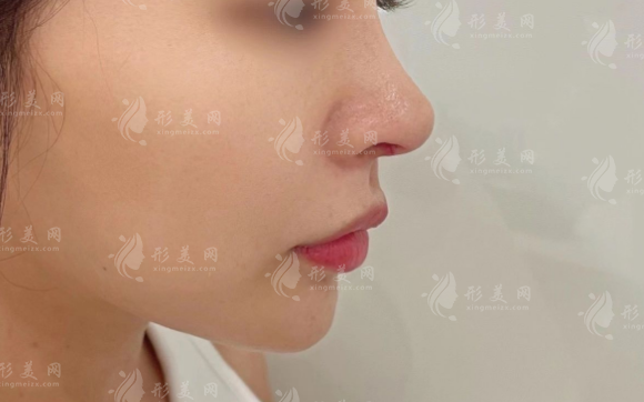 國(guó)產(chǎn)萬(wàn)春膨體怎么樣?臻挺臻美兩大系列隆鼻下巴型號(hào)價(jià)格解析