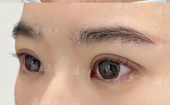上海鄭小紅雙眼皮修復(fù)怎么樣?20年經(jīng)驗閉眼無痕技術(shù)價格8000起