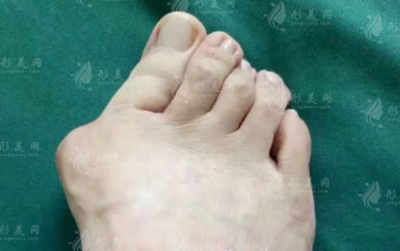 溫建民微創(chuàng)治大腳骨靠譜嗎？術(shù)后效果與費(fèi)用詳解