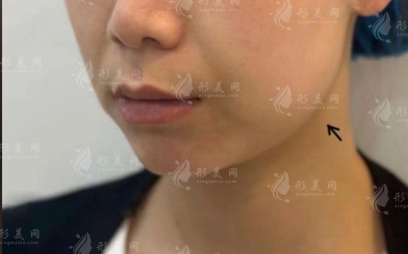 下頜線(xiàn)和下顎線(xiàn)分不清？側(cè)臉清晰的秘密全在這
