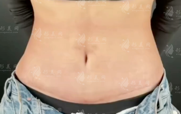 成都腹壁整形選誰好?劉亞平vs李獻(xiàn)和技術(shù)口碑大比拼