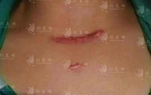 重慶祛疤醫(yī)院哪家好？軍科華美疤痕科口碑技術雙在線