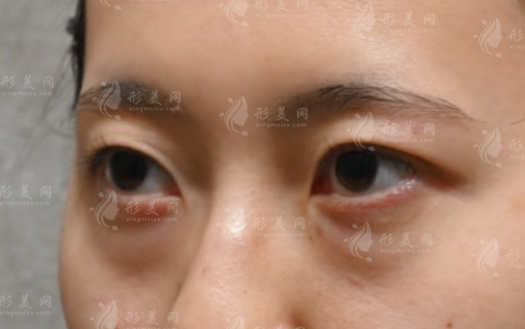 廣州曙光去眼袋6200元起，不開刀術(shù)式靠譜嗎?價格差異真相揭秘