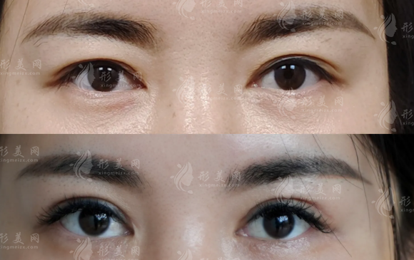 武漢眼修復(fù)醫(yī)生怎么選?王海平與項(xiàng)利姣技術(shù)對(duì)比+費(fèi)用揭秘! 武漢眼修復(fù)醫(yī)生怎么選?王海平與項(xiàng)利姣技術(shù)對(duì)比+費(fèi)用揭秘!