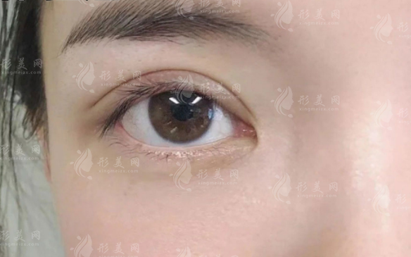 武漢楊蓉雙眼皮多少錢?2026埋線/三點/全切價格表曝光!