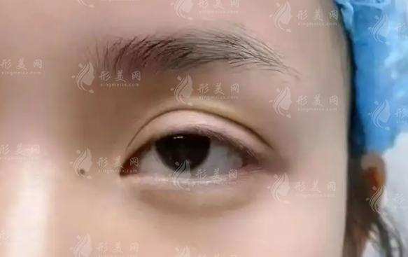北京雙眼皮修復(fù)選師麗麗還是李燕?技術(shù)風(fēng)格對(duì)比+2026價(jià)格揭秘