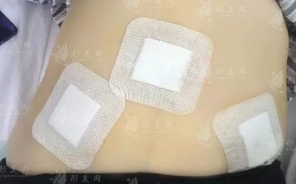 超能電漿抽脂vs傳統(tǒng)抽脂怎么選?2026最新技術(shù)對比+避坑指南