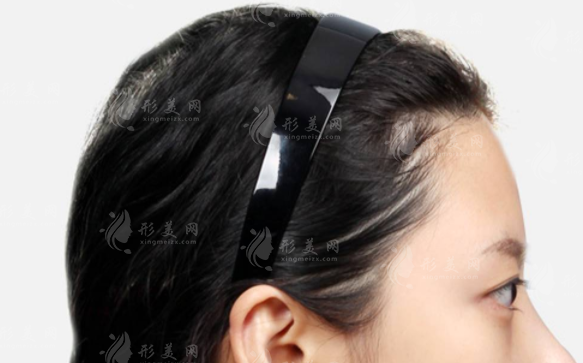 骨水泥顱頂填充術(shù)多少錢?手術(shù)全過程及價格表一覽