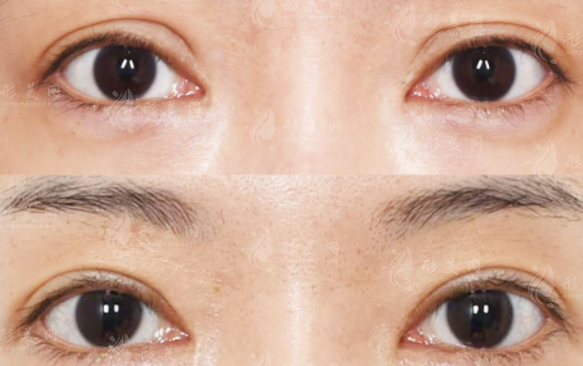 劉志剛雙眼皮修復(fù)怎么樣?假寬深眼修復(fù)技術(shù)解析