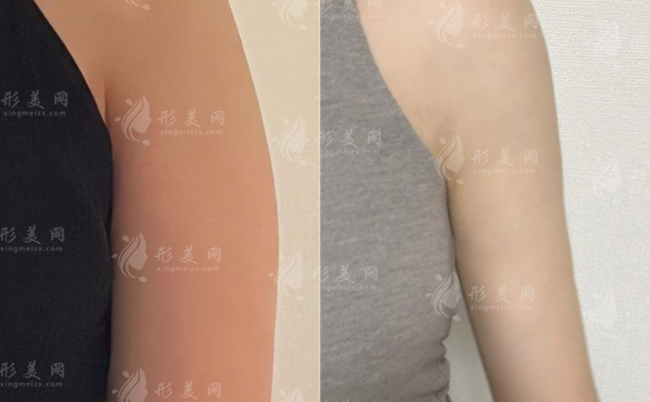 南京米嘉徐鶴然吸脂靠譜嗎?脂肪填充+威塑抽脂技術(shù)解析