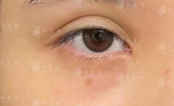 上海馬娟雙眼皮修復(fù)口碑揭秘：自然無(wú)痕技術(shù)獲認(rèn)可