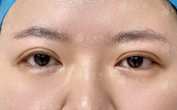 雙眼皮做寬了能改窄嗎?修復(fù)避坑指南+醫(yī)生推薦