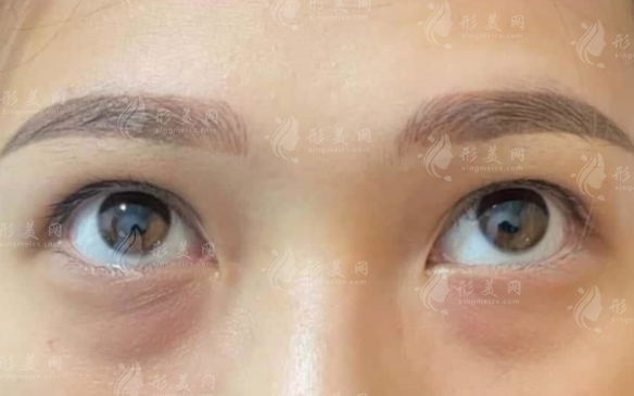 淚溝填充選膠原蛋白還是玻尿酸?維持時(shí)間效果對比