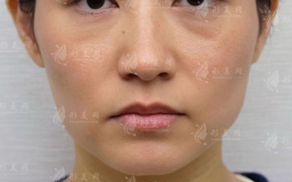 童顏線提升多少錢?2026價格揭秘+適合人群分析 童顏線提升多少錢?2026價格揭秘+適合人群分析