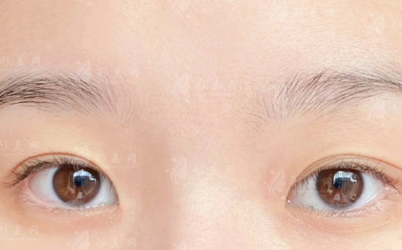 西安雙眼皮避坑指南：這10家正規(guī)醫(yī)院閉眼入不踩雷