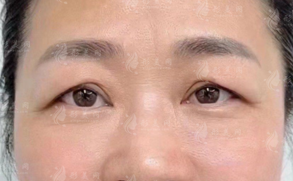 張冰潔眼修復(fù)靠譜嗎?20年經(jīng)驗+上萬案例深度解析 張冰潔眼修復(fù)靠譜嗎?20年經(jīng)驗+上萬案例深度解析