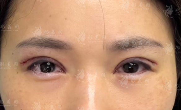 鄭州段珊珊雙眼皮靠譜嗎?楊麗嫡傳弟子技術(shù)揭秘