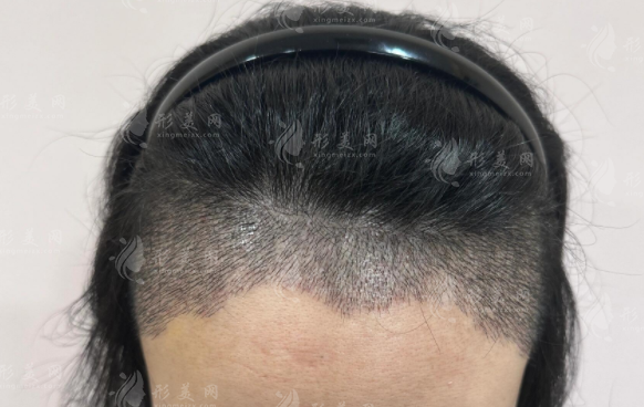 M型發(fā)際線拯救指南：山羊角禿額角3種修復方案對比