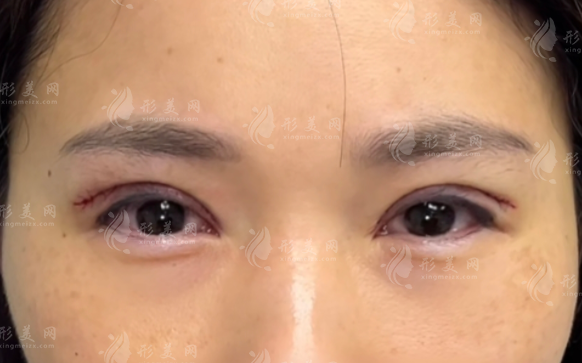 北京張冰潔眼修復(fù)技術(shù)怎么樣?真實(shí)評價揭秘不踩坑
