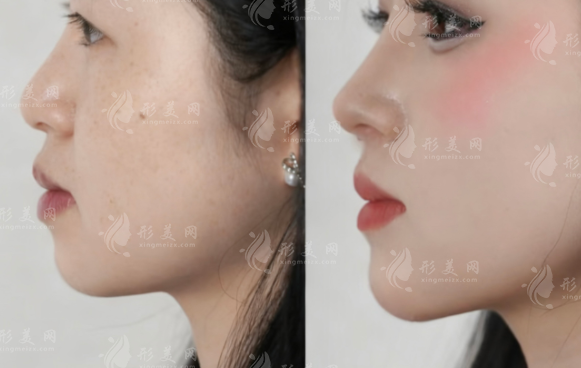 隆鼻后鼻子不舒服?教你分辨假體過敏與排異反應(yīng)