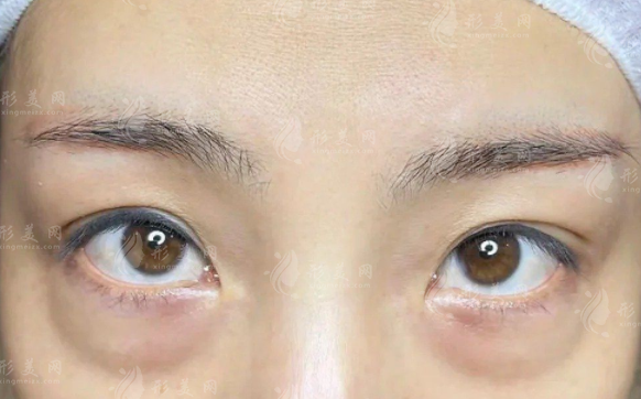 沈陽美萊祛眼袋怎么樣?醫(yī)生技術(shù)+價格表全揭秘