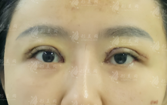 石家莊雙眼皮修復(fù)哪家好?靠譜醫(yī)院醫(yī)生排名推薦