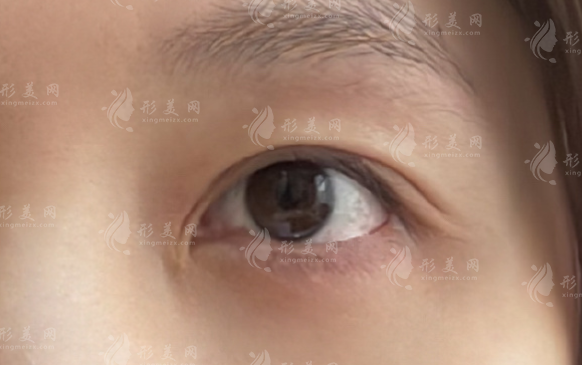 上海雙眼皮修復(fù)選誰(shuí)好?張園園/許炎龍技術(shù)風(fēng)格深度解析 上海雙眼皮修復(fù)選誰(shuí)好?張園園/許炎龍技術(shù)風(fēng)格深度解析