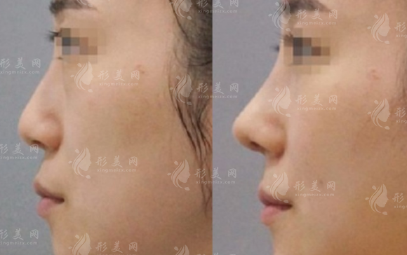 北京鼻修復(fù)醫(yī)生哪家好?徐永成/韓興斌/孫波等十大專家實(shí)力盤點(diǎn)