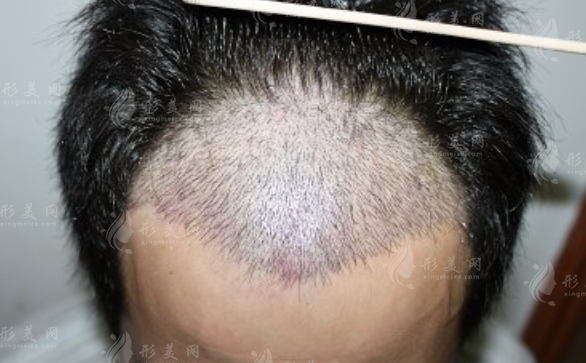 國內(nèi)連鎖植發(fā)醫(yī)院哪家好?十大正規(guī)機構(gòu)排名及春草植發(fā)地址價格