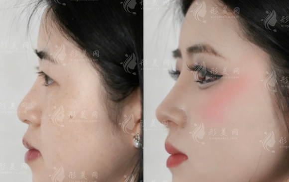 玻尿酸隆鼻能挺多久?6-12個月維持秘訣全揭秘 玻尿酸隆鼻能挺多久?6-12個月維持秘訣全揭秘