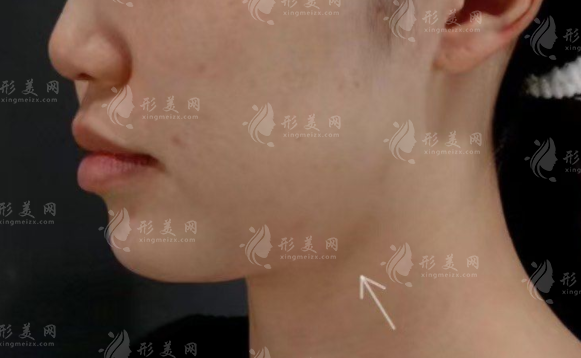 樸正國做下頜角怎么樣?長曲線截骨技術(shù)口碑價格全解析
