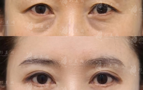 哈爾濱羽禪楊宇梓怎么樣?20年眼整形經(jīng)驗技術(shù)口碑全解析