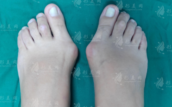 蘇敬達和馬桂文做大腳骨誰更好?技術風格價格全面對比