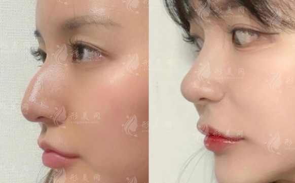 怎么找深圳文豐醫(yī)生做鼻子?從預(yù)約到面診全指南