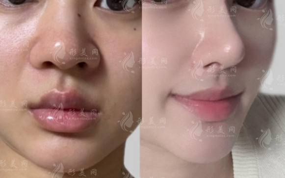 濡白天使vs瑞藍(lán)麗瑅隆鼻怎么選?成分/維持/價(jià)格全面對(duì)比