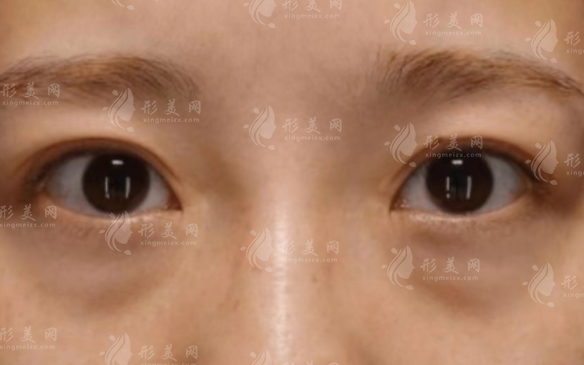 光能祛眼袋效果好嗎?和激光祛眼袋區(qū)別在哪?90%人分不清