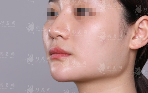 廣州磨下頜角醫(yī)院哪家好?5家正規(guī)醫(yī)院醫(yī)生排名推薦