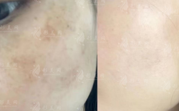 超皮秒除了祛斑還能干啥?5大隱藏功能全揭秘