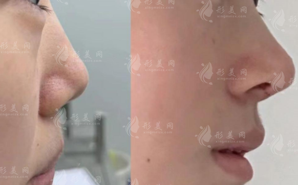 想找深圳文豐醫(yī)生隆鼻？預(yù)約渠道+面診攻略全解析
