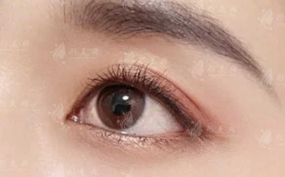 鄭州蔡連朋雙眼皮技術(shù)怎么樣?同樂醫(yī)院坐診自然無痕