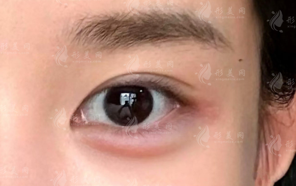 鄭州王楊醫(yī)生臥蠶修復(fù)多少錢?2026價(jià)格表及眼袋費(fèi)用一覽
