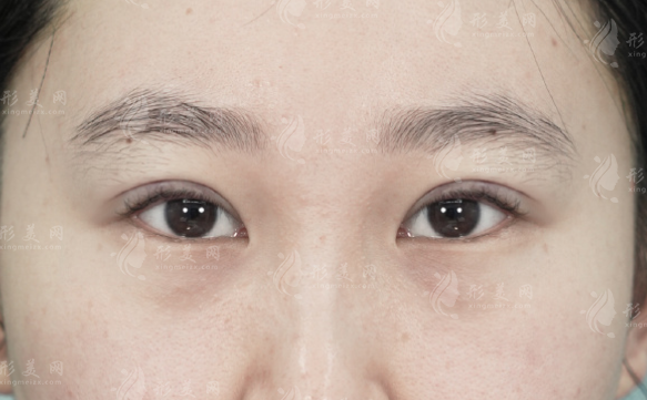 西安雙眼皮修復(fù)誰做得好?孫峰/葉桐江/宋蔚等醫(yī)生實(shí)力盤點(diǎn)