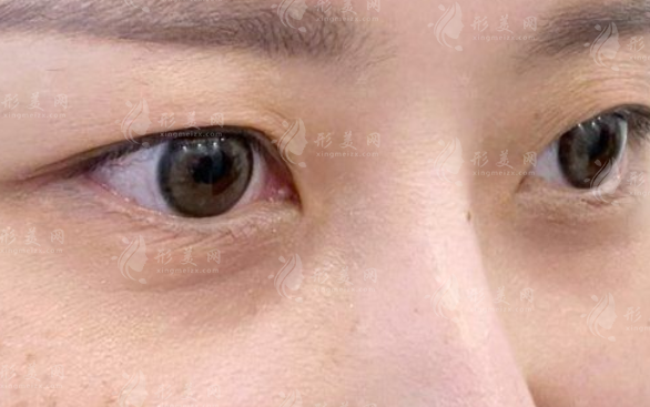 眼袋淚溝黑眼圈怎么區(qū)分?辨別方法與改善方案全攻略