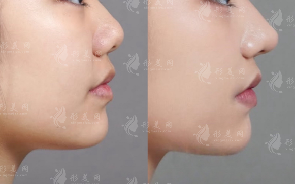 上海柳棒醫(yī)生隆鼻靠譜嗎?自然風(fēng)格+技術(shù)優(yōu)勢(shì)深度解析