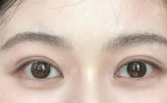武漢做雙眼皮哪家醫(yī)院好?前十正規(guī)機構(gòu)技術(shù)特點盤點