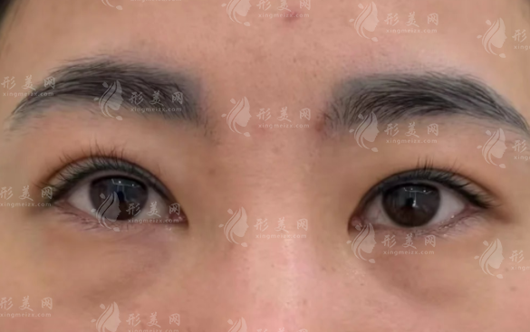 咸陽(yáng)做眼袋手術(shù)哪家好?三家正規(guī)機(jī)構(gòu)排名推薦