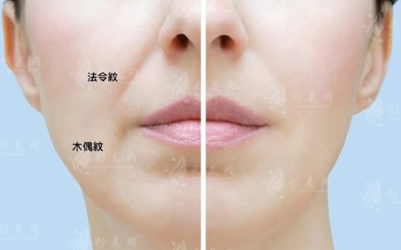 法令紋明顯該填玻尿酸還是做提拉？一文看懂怎么選