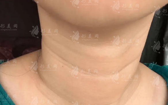 頸紋怎么消除?日常護(hù)理+醫(yī)美方法全攻略