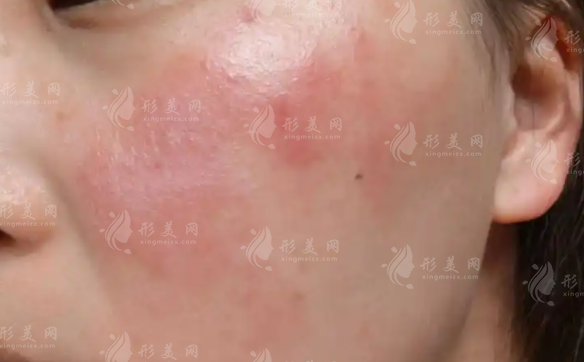 敏感肌屏障受損怎么修復(fù)?急救攻略+護膚指南