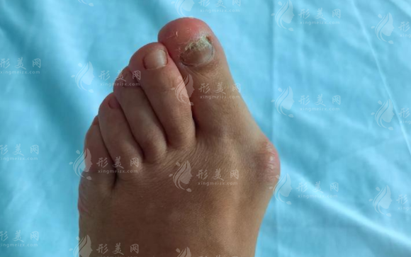 溫建民拇外翻手術(shù)靠譜嗎?微創(chuàng)技術(shù)+費(fèi)用+適合人群詳解